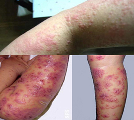 各种湿疹症状你属于哪一种？
