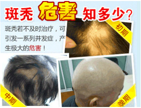 哪些因素导致斑秃？