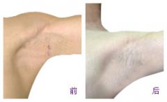 腋臭没了 终于实现了当兵